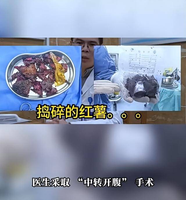 皇冠hga030
_61岁男子将17cm红薯塞入肛门皇冠hga030
,半夜疼痛难忍被迫就医,医生:尺寸过大,得开腹