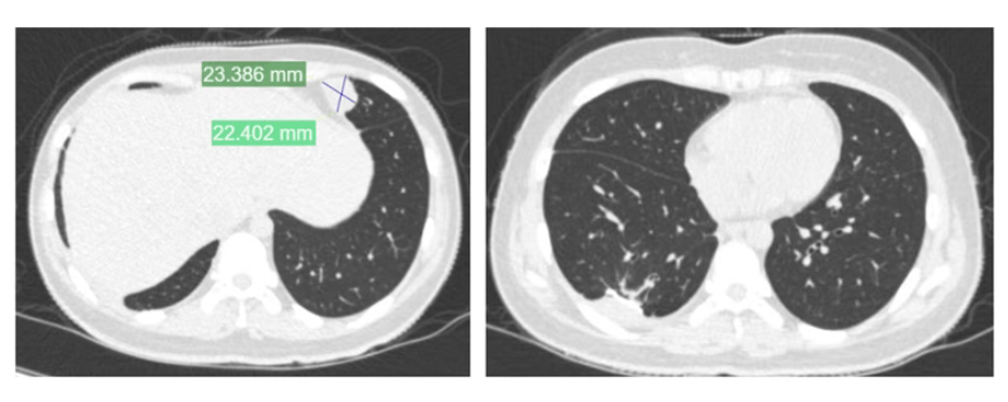 皇冠信用盘代理
_女孩高考晕倒确诊骨癌!自己签字进行6次手术截肢皇冠信用盘代理
,上海医生全力救治